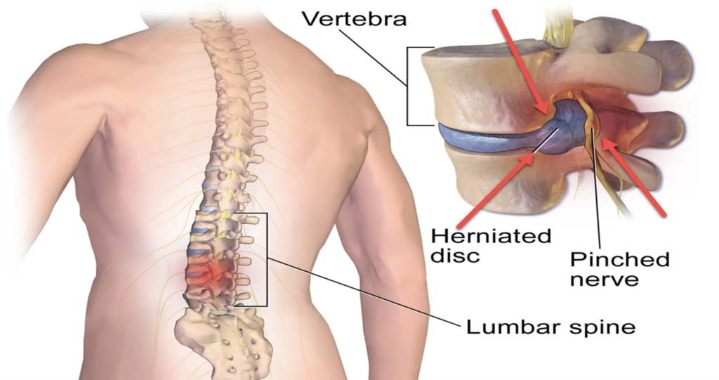 is-it-a-herniated-disc-a-bulging-disc-or-a-pinched-nerve-accent-on