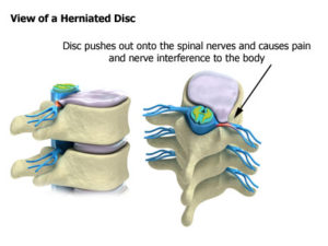 Disc And Sciatic Relief With Kdt Spinal Decompression Therapy - Accent 