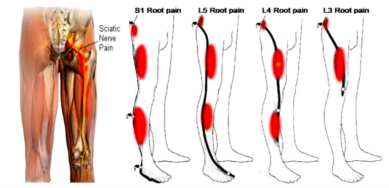 Chiropractic Treatment Of Sciatica Or Leg Pain Accent On Health 